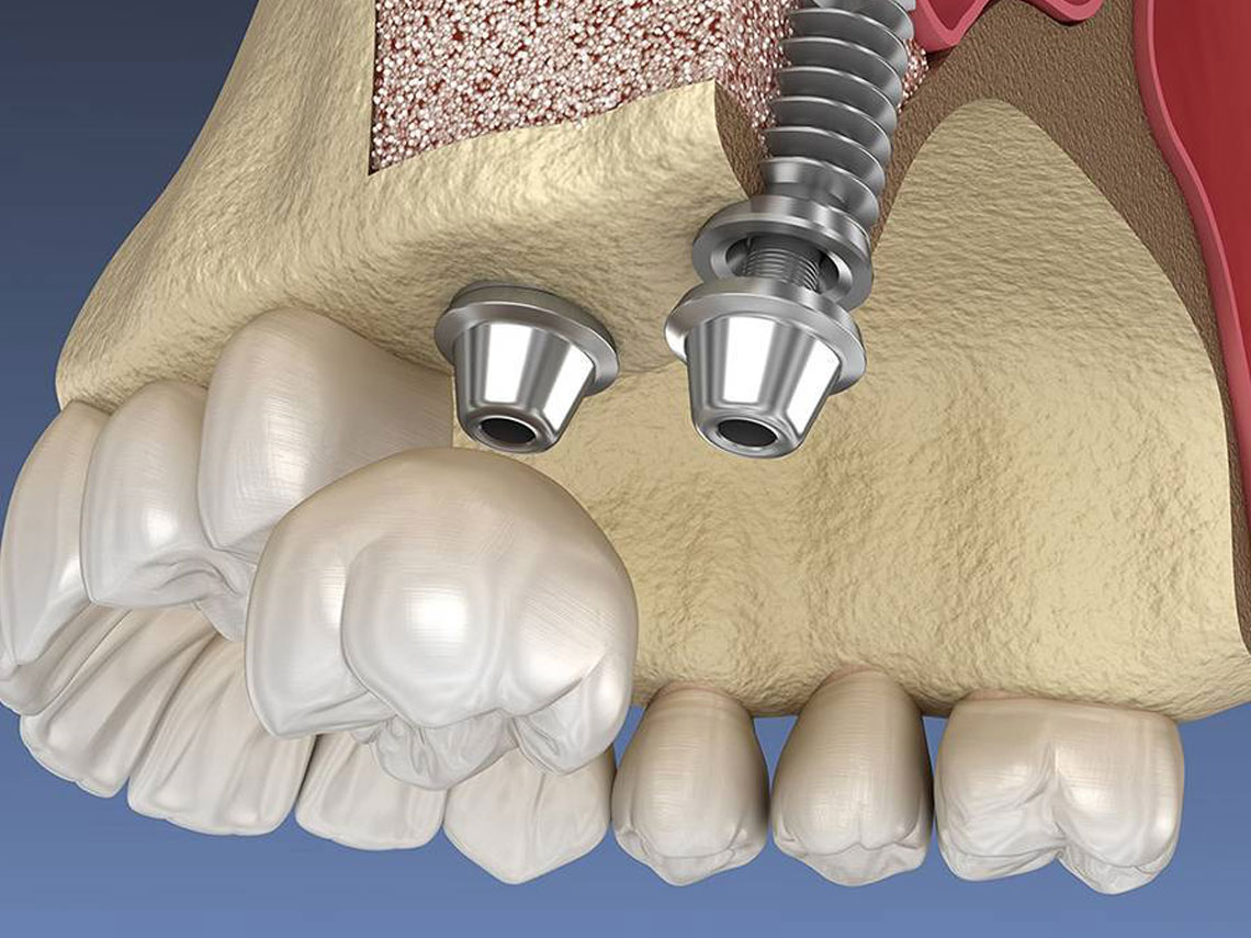 Graft And Sinus Lifting - Abay Dental