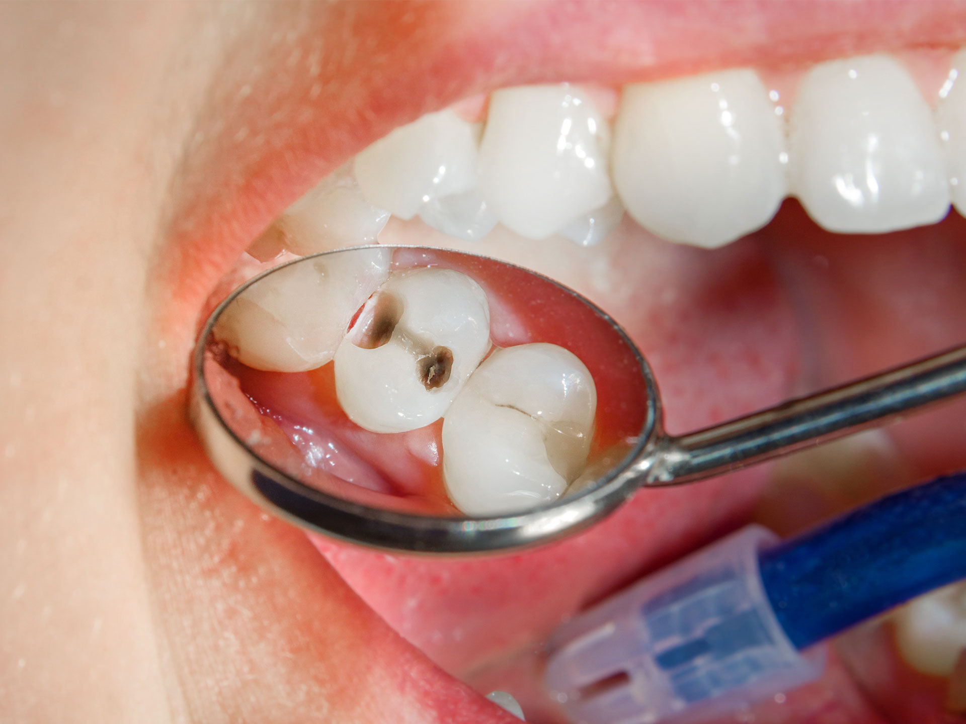 composite-fillings-comfort-dentistry-cosmetic-family-dentist